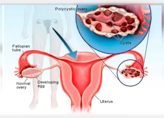 PCOS – Do You Know These Facts to Manage It Better?